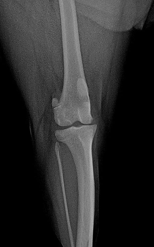TPLO-M 2.4 with Smartvet polyaxial symmetrical TPLO plate (R15)