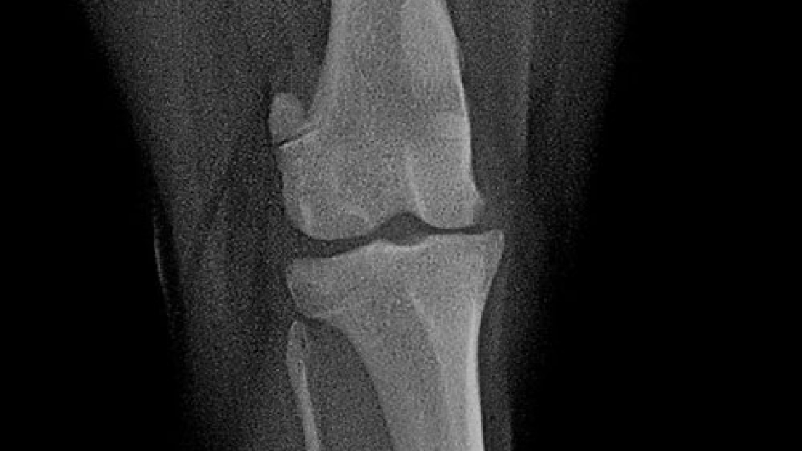 TPLO-M 2.4 with Smartvet polyaxial symmetrical TPLO plate (R15)