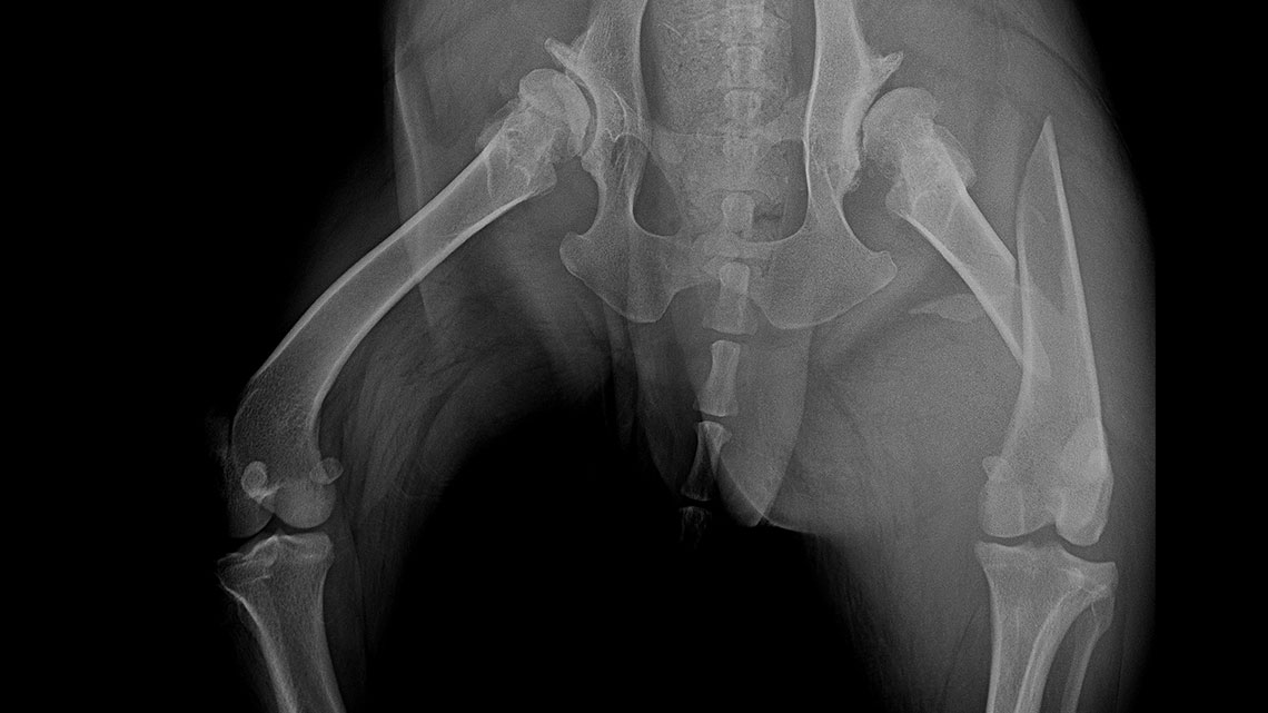 Combination of polyaxial locking plating and medullary pinning to treat multiple unstable fractures