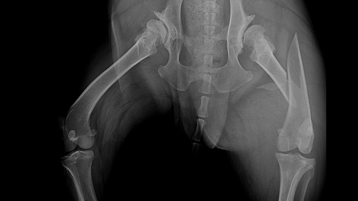 Combination of polyaxial locking plating and medullary pinning to treat multiple unstable fractures