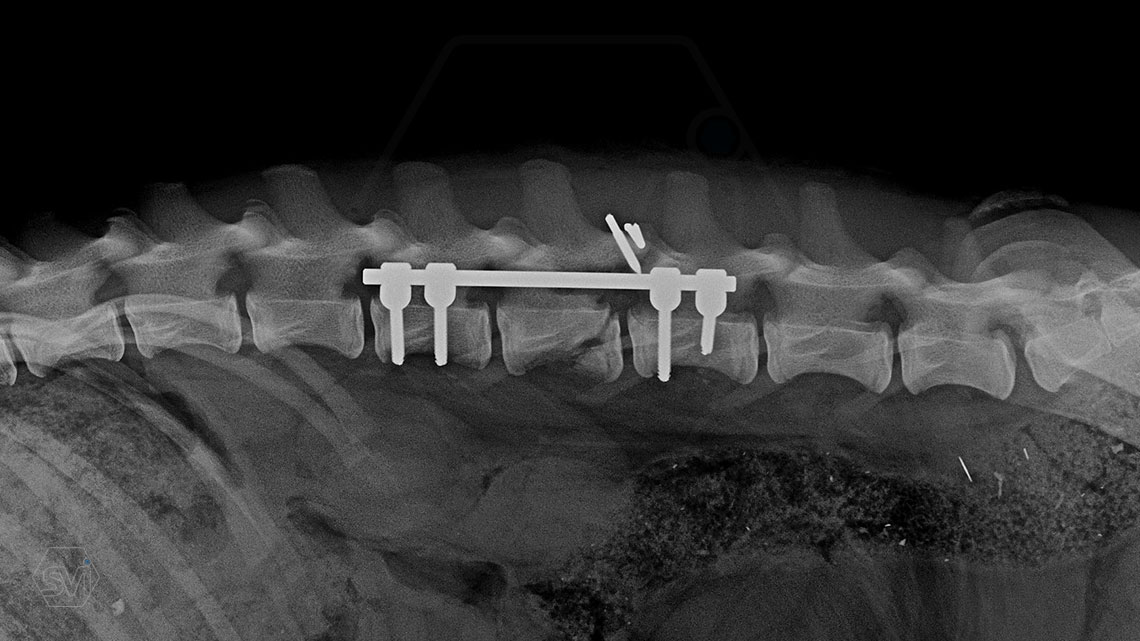 The best method to stabilize the spine is our patented SOP-LC system.