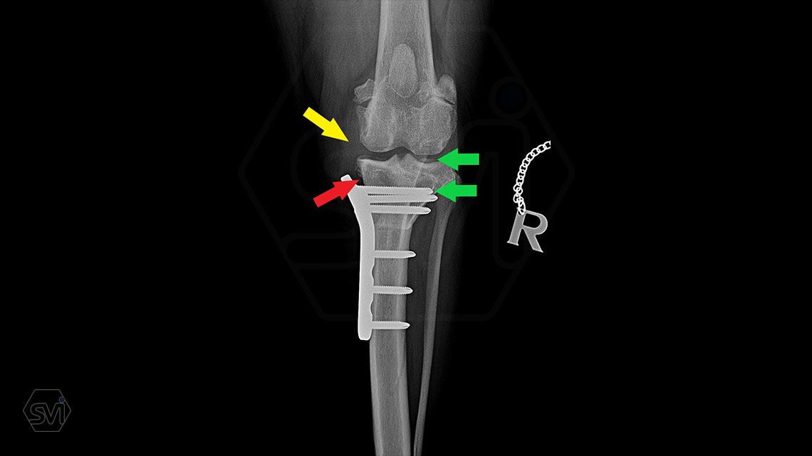 Tips for using precontuered poliaxial locking TPLO plates