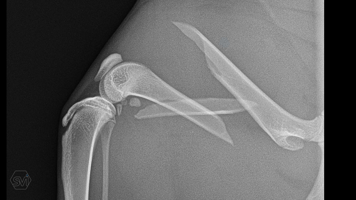 NEW! The polyaxial locking system in size 2.0 mm have arrived!