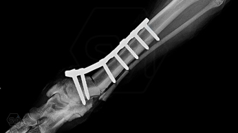Multifunctional symmetrical long polyaxial locking plate - designed for the treatment of fractures close to joints