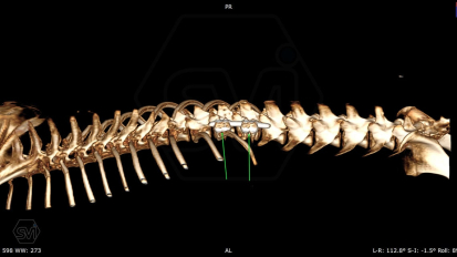 If it is spinal trauma, then SOP-LC (Sliding On Pivot Locking Claps)