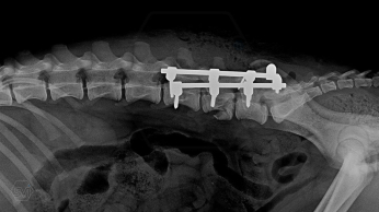 L6 vertebral body fracture fixation with 2.7-mm SOP-LC system