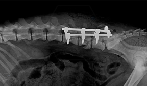 L6 vertebral body fracture fixation with 2.7-mm SOP-LC system