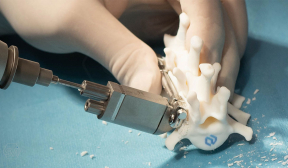 With the help of new clamp fixator and drill guide device, using the SOP-LC system is now “child’s play”