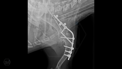 If it's shoulder arthrodesis, then SOP-LC!