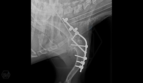 If it's shoulder arthrodesis, then SOP-LC!